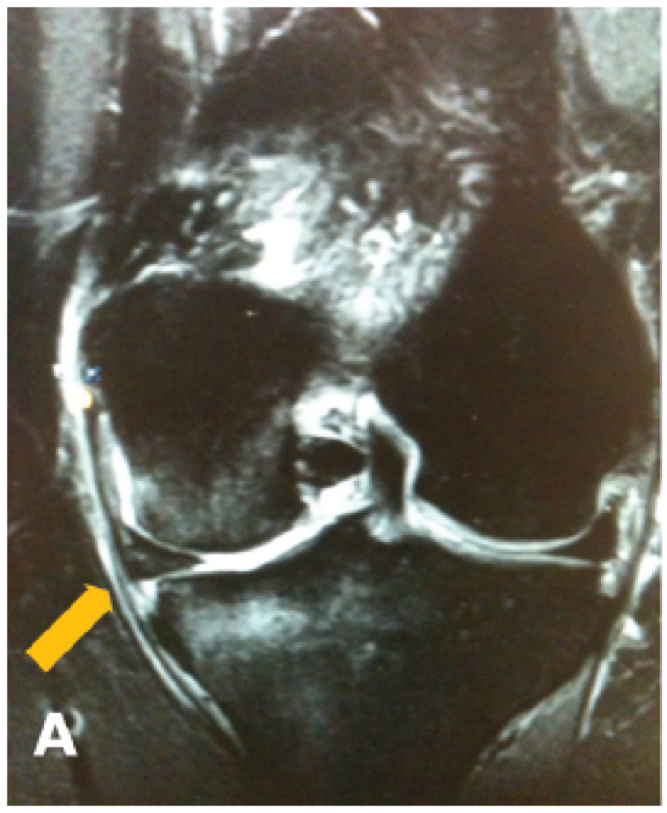 Meniscal Root Tear MRI